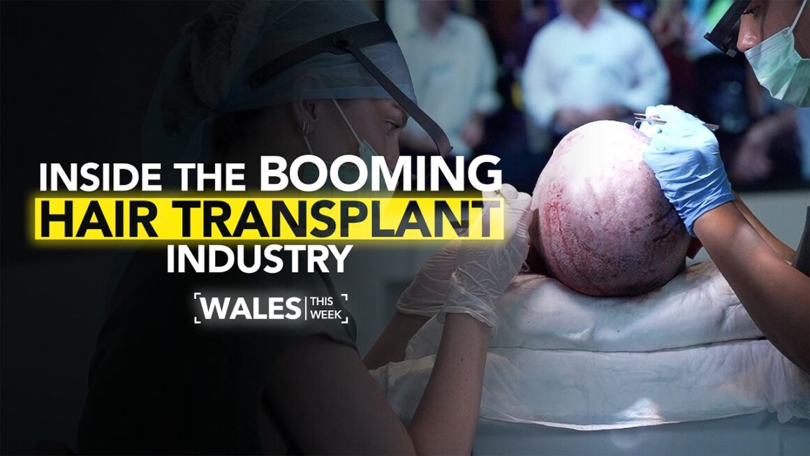 Are hair transplants putting people at risk? | Wales This Week | ITV Cymru Wales